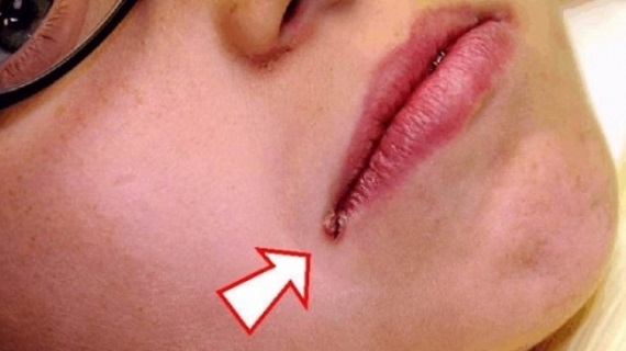 συγχειλίτιδα