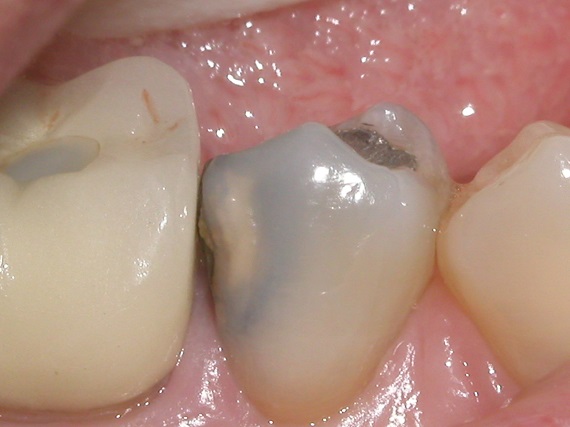 τερηδόνα αθώα