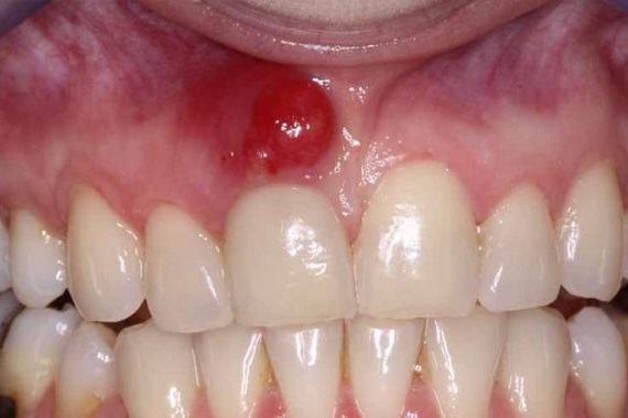 Κύστη Στα Ούλα (Οδοντικό Απόστημα) κυστες στα ουλα