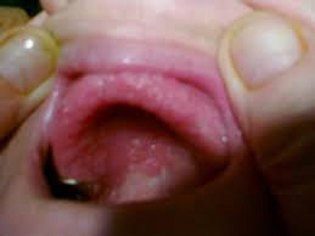 Στοματίτιδα Από Οδοντοστοιχίες στοματιτιδα