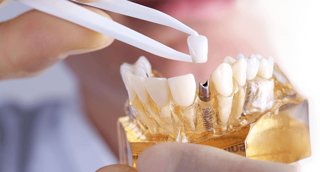 Ποιο είναι το καλύτερο οδοντικό εμφύτευμα και τα κριτήρια επιλογής: τύπος, μάρκα, υλικά, ποιότητα κατασκευής