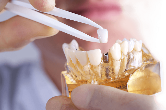 Ποιο είναι το καλύτερο οδοντικό εμφύτευμα και τα κριτήρια επιλογής: τύπος, μάρκα, υλικά, ποιότητα κατασκευής ΕΜΦΥΤΕΥΜΑ 1