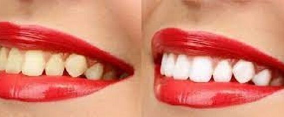 Γιατί Κιτρινίζουν Τα Δόντια Και Ποιες Είναι Οι Πιο Αποτελεσματικές Θεραπείες Για Τα Κίτρινα Δόντια