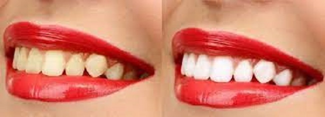 Γιατί Κιτρινίζουν Τα Δόντια Και Ποιες Είναι Οι Πιο Αποτελεσματικές Θεραπείες Για Τα Κίτρινα Δόντια